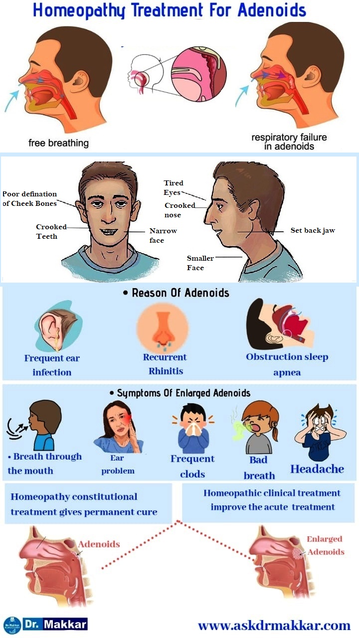 Adenoid Adenoid Facies Nasal Polyp Causes Homeopathic